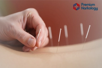 Врач проводит сеанс иглоукалывания